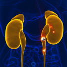 Piedras o Litiasis